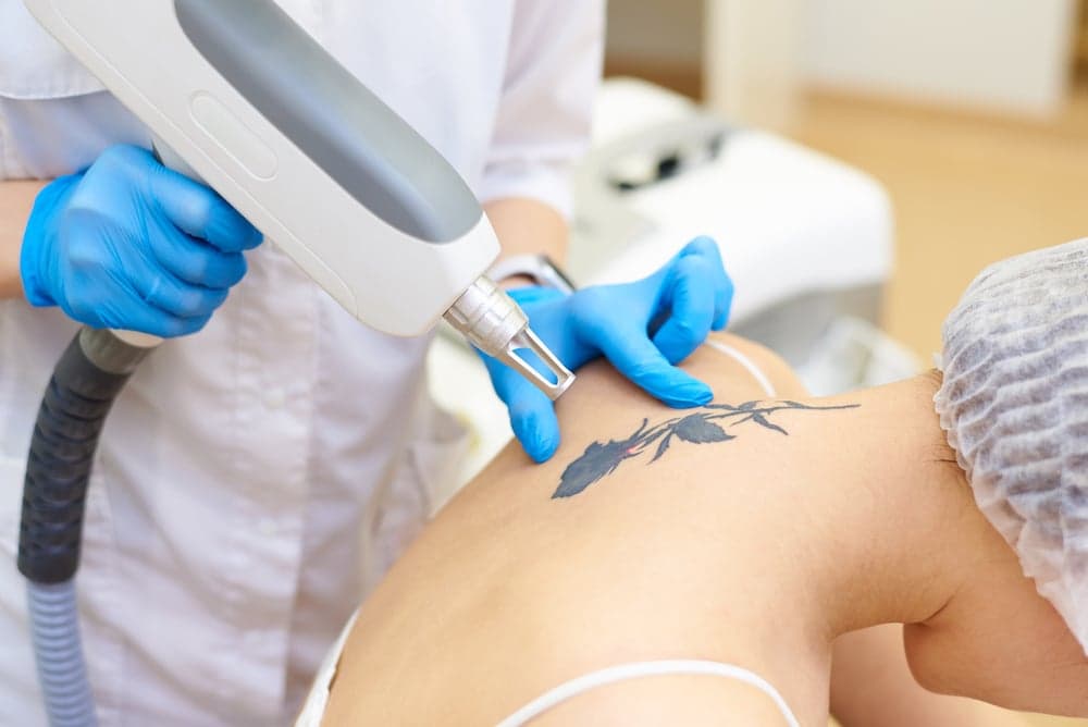 8 preguntas frecuentes sobre la eliminación de tatuajes con láser