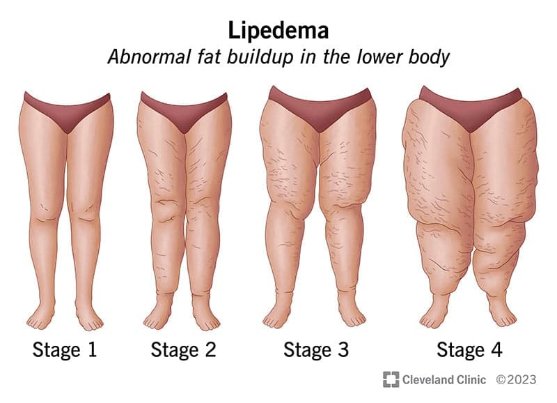 Famosos que podrían padecer lipedema: 9 celebridades.