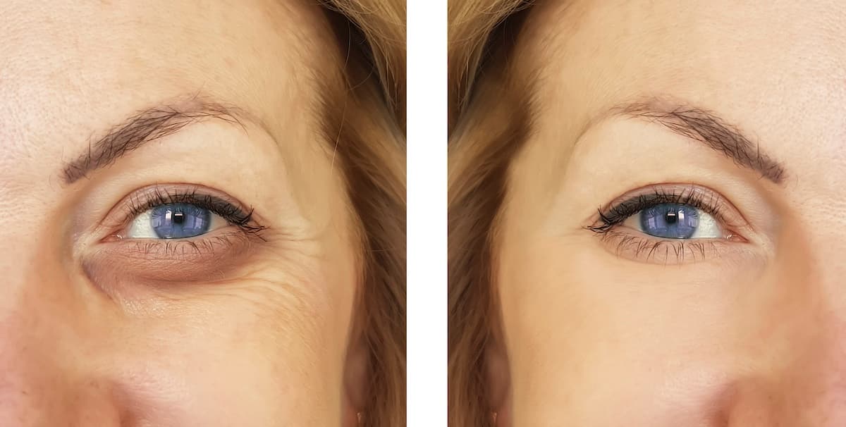 El asombroso origen de tus ojeras y cómo remediarlas.