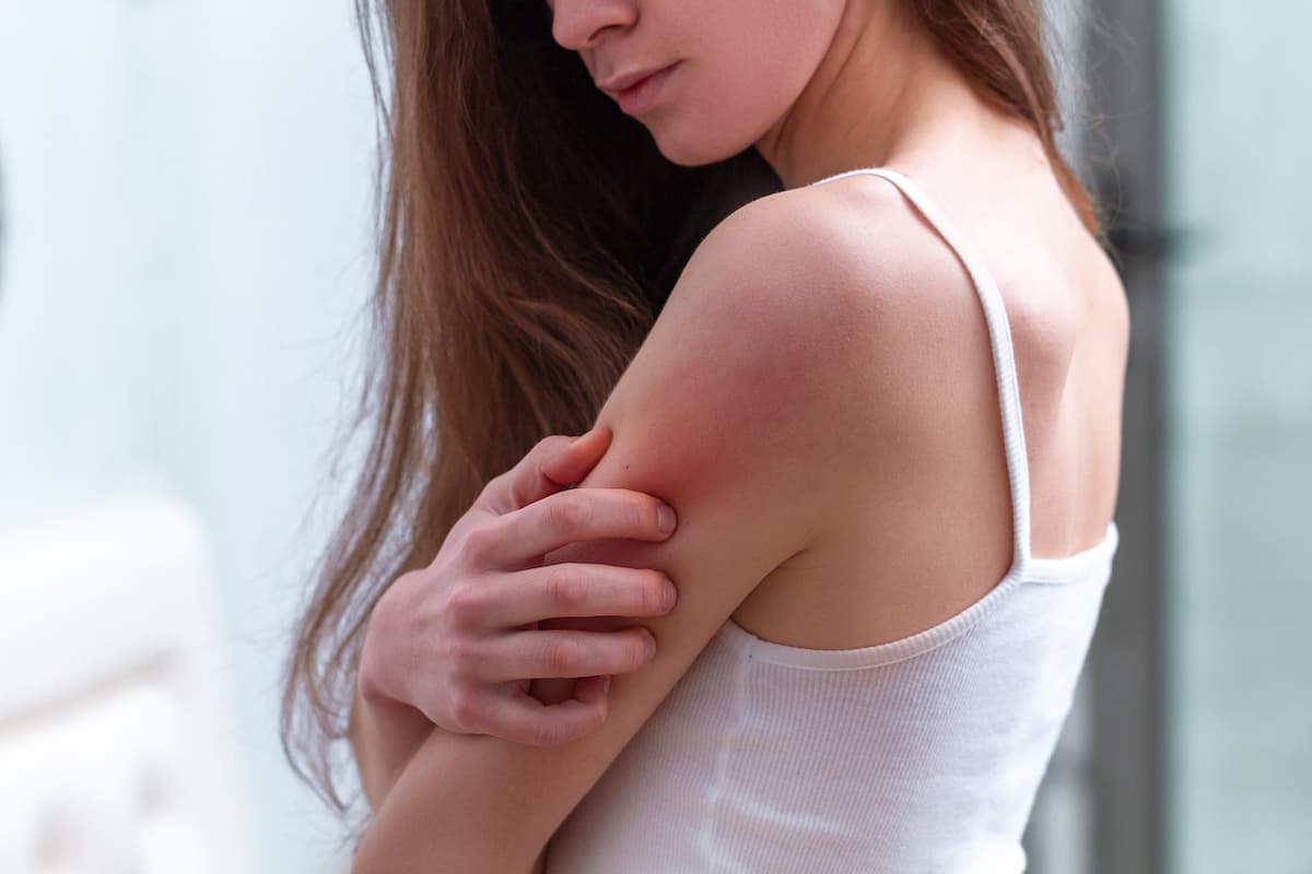 11 métodos para manejar la psoriasis en el hogar.