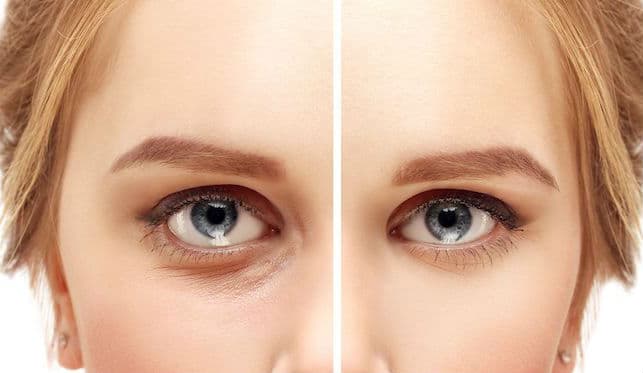 Blefaroplastia: intervención en los párpados para lucir más renovado y juvenil.