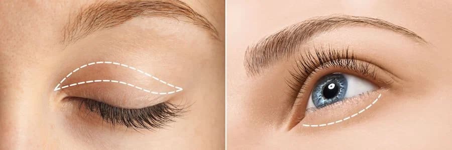 Cirugías estéticas de párpados Blefaroplastia – cirugía de párpados para una mirada más fresca y joven Su Belleza