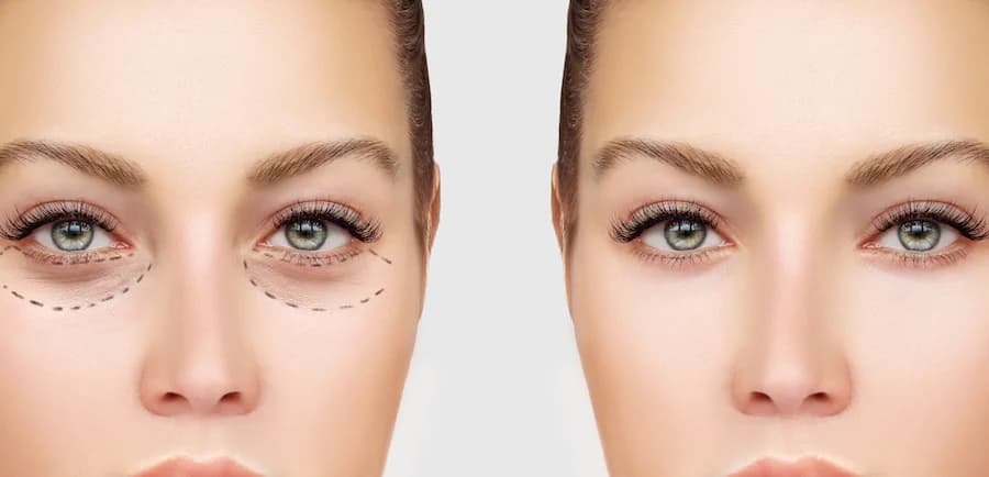 Cirugía de párpados superiores Blefaroplastia – cirugía de párpados para una mirada más fresca y joven His Beauty