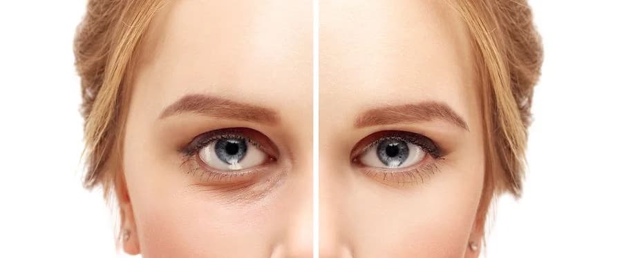 Cirugía de párpados inferiores Blefaroplastia – cirugía de párpados para una mirada más fresca y joven His Beauty