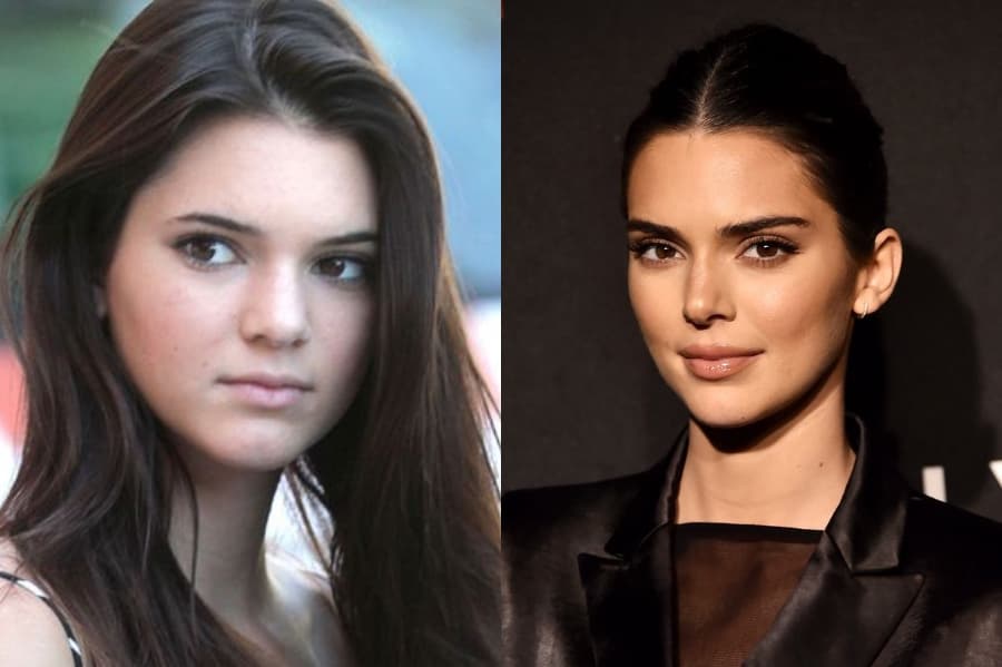 Cirugía plástica de Kendall Jenner |: 7 datos interesantes sobre Kendall Jenner |: HerBeauty: