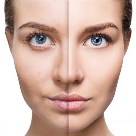 Resultados del pelado | ¿Qué es la microdermoabrasión y mejorará tu piel? su belleza