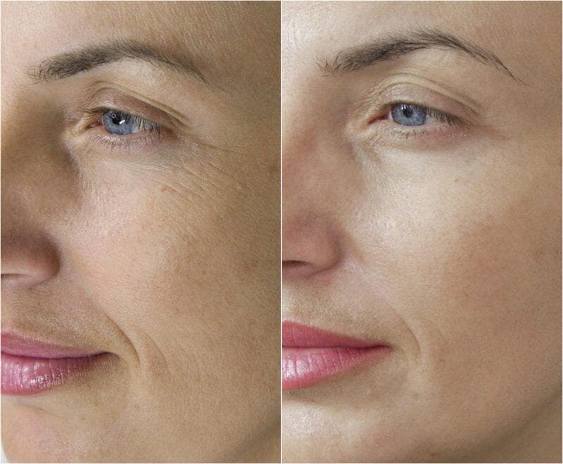 Microneedling antes y después | Todo lo que necesitas saber sobre Microneedling | su belleza