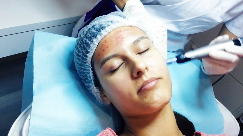 Hinchazón e irritación leve | Todo lo que necesitas saber sobre Microneedling | su belleza