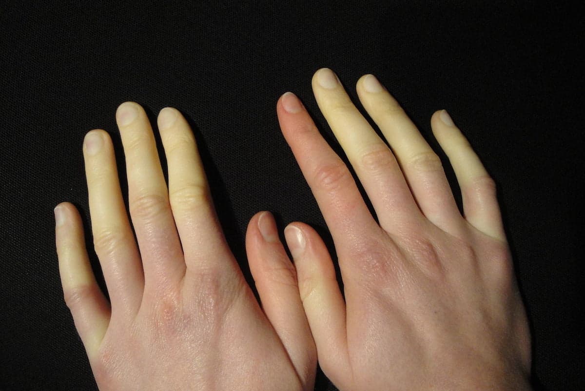 ¿Por qué siempre tienes las manos frías? Un trastorno de vasoconstricción llamado Raynaud.