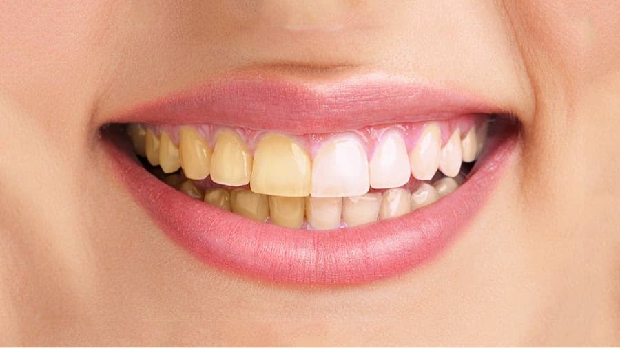 5 aspectos fundamentales que todos deben conocer sobre el blanqueamiento dental.
