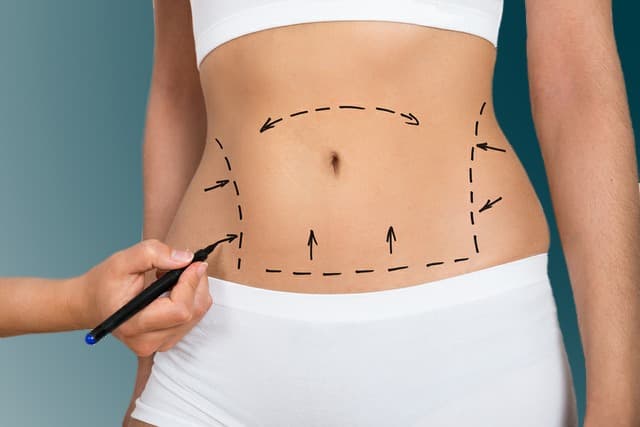 Cirujano plástico certificado | Todo lo que necesitas saber sobre la abdominoplastia no quirúrgica | su belleza