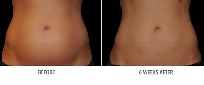 Los resultados no son inmediatos: Qué hacer y qué no hacer con Coolsculpting | su belleza