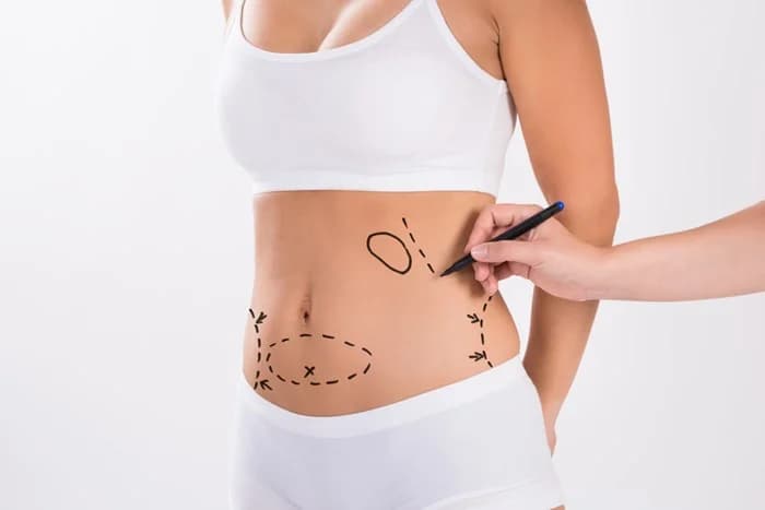 ¿Cómo funciona la escultura en frío? |: Qué hacer y qué no hacer en Coolsculpting | su belleza