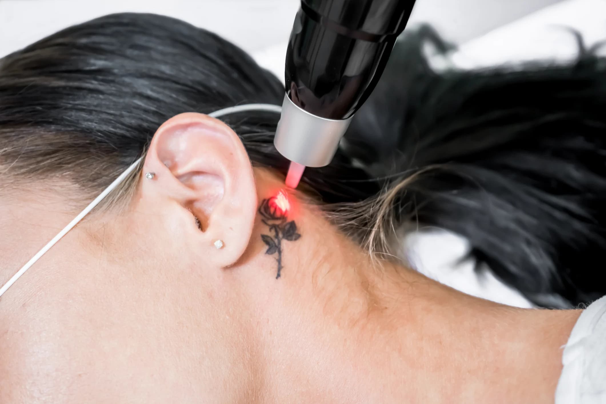 Preguntas comunes sobre la remoción de tatuajes mediante láser