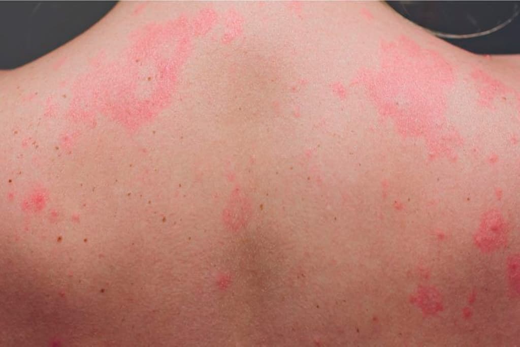 la alergia causa granos en la cara