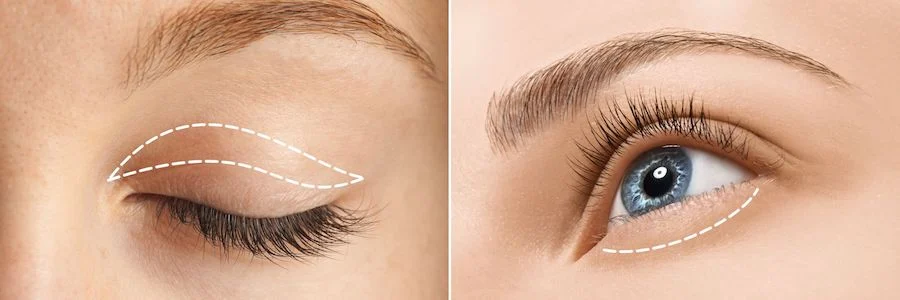 Cirugías estéticas de párpados Blefaroplastia – cirugía de párpados para una mirada más fresca y joven Su Belleza