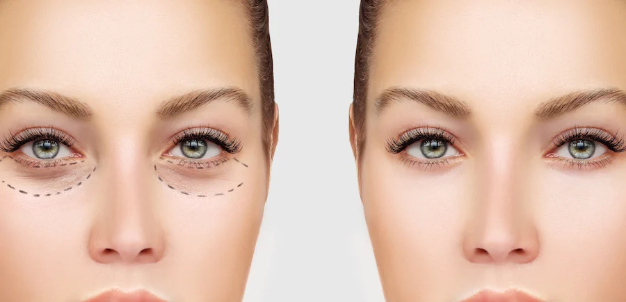 Cirugía de párpados superiores Blefaroplastia – cirugía de párpados para una mirada más fresca y joven His Beauty