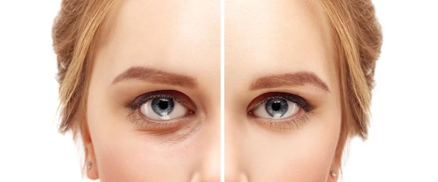 Cirugía de párpados inferiores Blefaroplastia – cirugía de párpados para una mirada más fresca y joven His Beauty