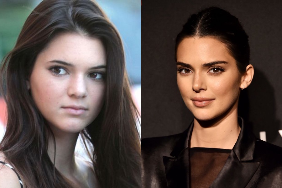 Cirugía plástica de Kendall Jenner |: 7 datos interesantes sobre Kendall Jenner |: HerBeauty: