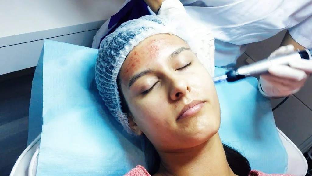 Hinchazón e irritación leve | Todo lo que necesitas saber sobre Microneedling | su belleza