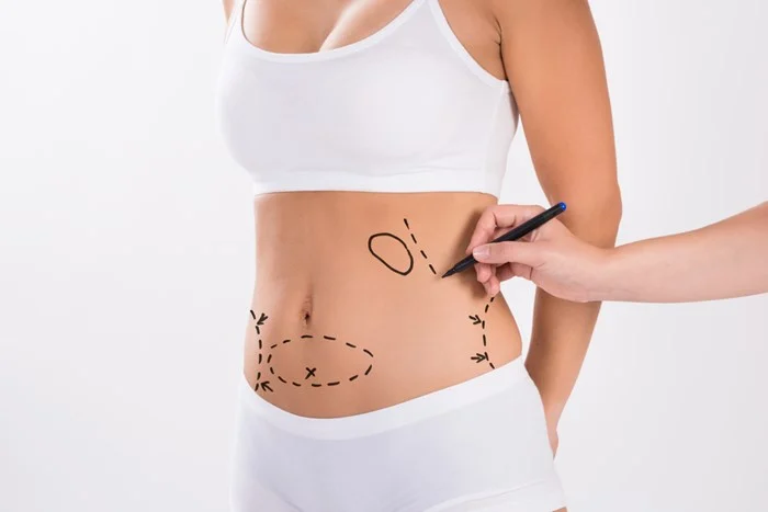 ¿Cómo funciona la escultura en frío? |: Qué hacer y qué no hacer en Coolsculpting | su belleza